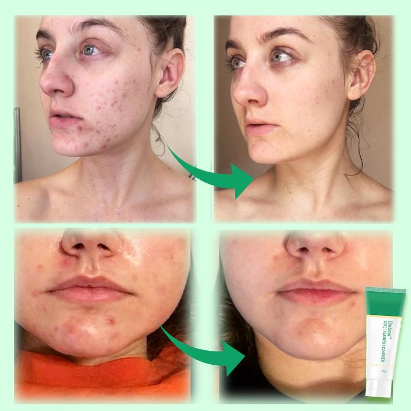 Detox aknės valymo priemonė - Image 2