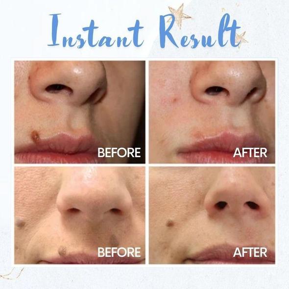 Dėmių pašalinimo rašiklis - Image 2